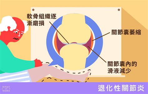 為什麼會骨枯|【髖關節炎】常見4大成因：關節退化、骨折 痛楚持續。